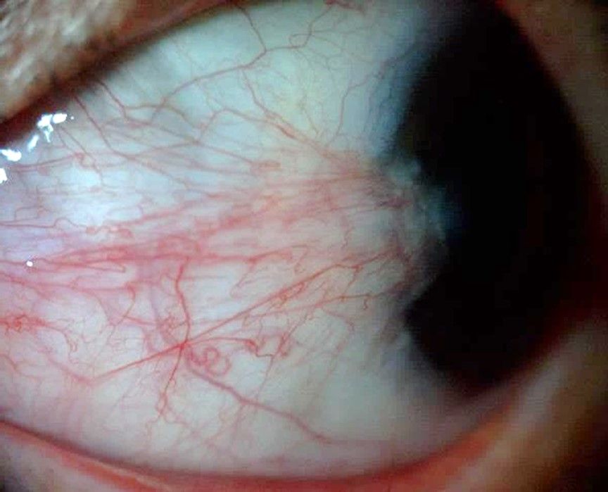 carnosidad en ojo